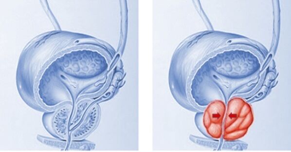 prostata sana e infiammata con prostatite